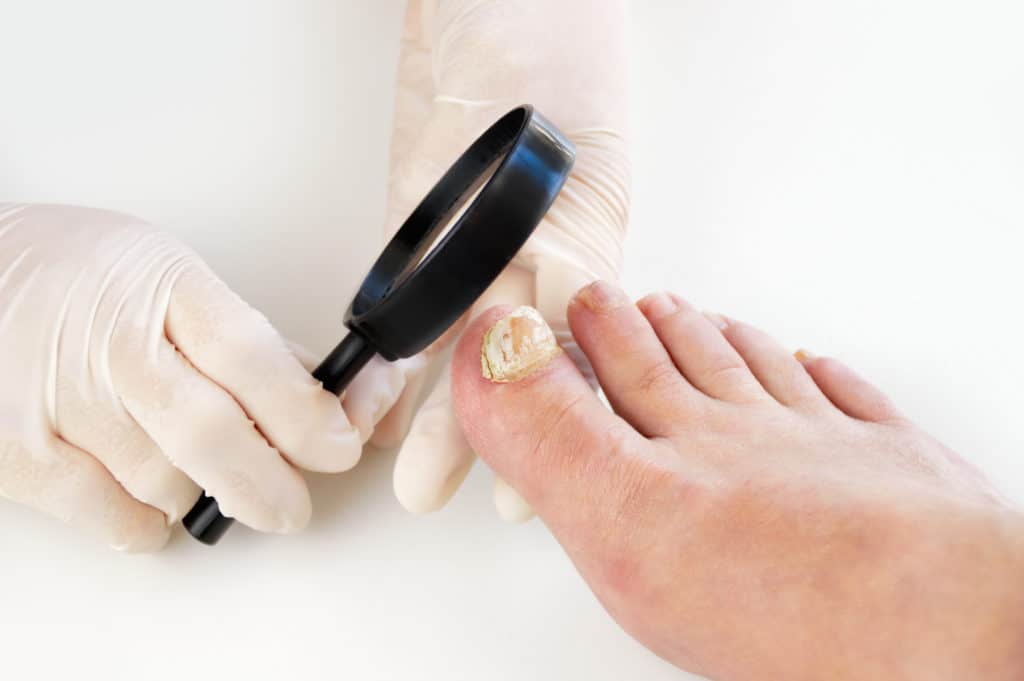 Arzt mit Lupe untersucht Fuß und Nagelpilz