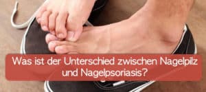 Read more about the article Nagelpsoriasis oder Nagelpilz? Unterschied erkennen!