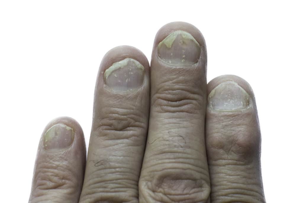 Nagelpsoriasis an den Fingernägeln