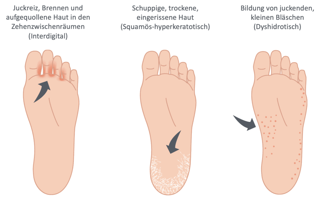 Fußpilz erkennt man an verschiedenen Symptomen und Ausprägungen. Auf der linken Seite sieht man die Bläschen in den Zehenzwischenräumen (interdigitale Form), in der Mitte an der Ferse (Squamös-hyperkeratotische Form) und rechts ist ein Bild mit Bläschen an der Fußaußenseite (dyshidrotische Form).