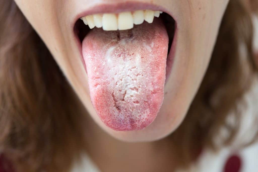 Belegte Zunge einer Frau, das ist ein Symptom von Mundsoor.