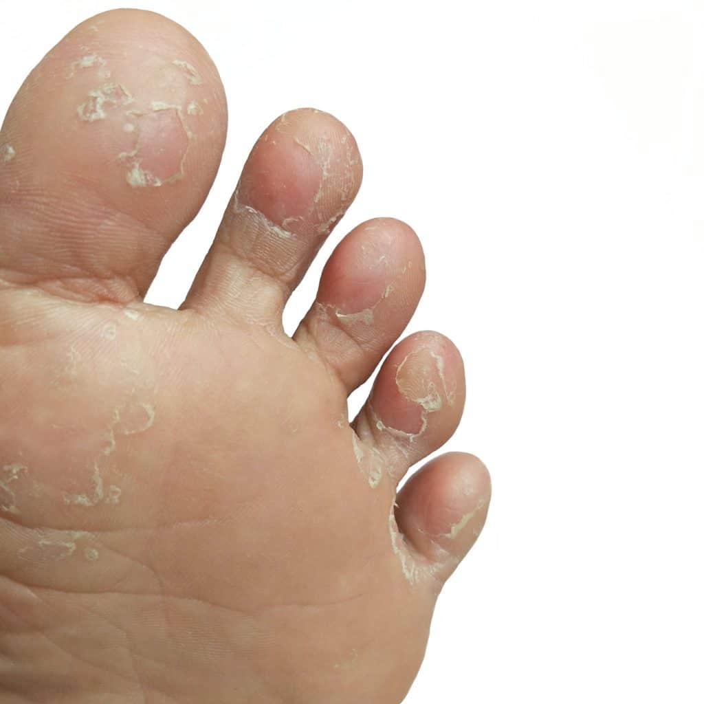 Bilder von Fußpilz - Einteilung der Symptome 