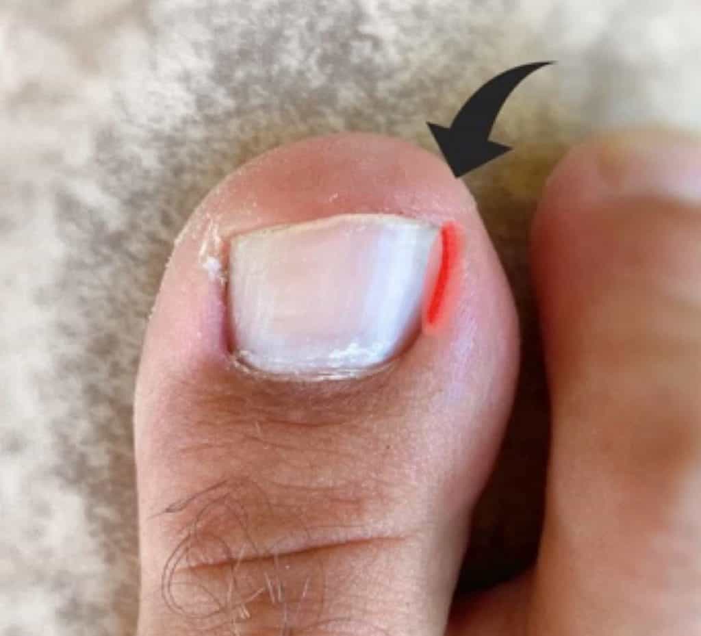 Fleisch finger wildes nagelbettentzündung Eingewachsener Zehennagel