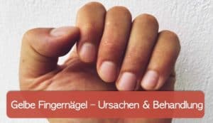 Read more about the article Gelbe Fingernägel: was bedeuten sie und was kann man dagegen tun?
