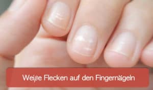 Read more about the article Weiße Flecken auf den Fingernägeln und weitere Verfärbungen der Nägel