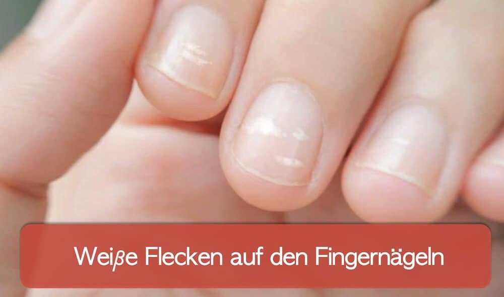 You are currently viewing Weiße Flecken auf den Fingernägeln und weitere Verfärbungen der Nägel