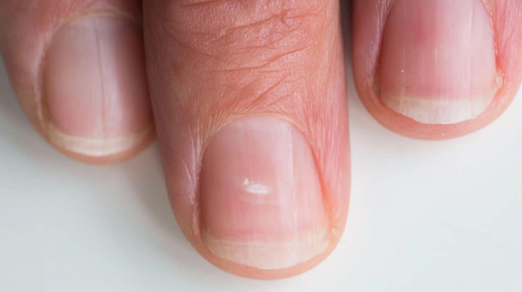Der Nagel des Mittelfingers hat einen weißen Fleck.