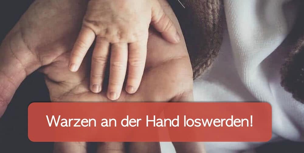 You are currently viewing Warze an der Hand entfernen: Helfen Hausmittel?
