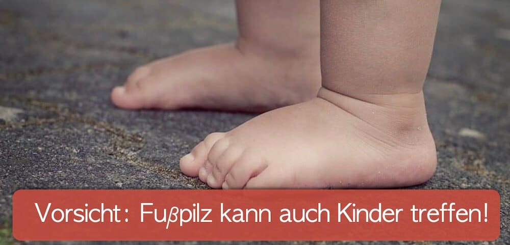 Zwei Füße eines Kindes, diese können auch von Fußpilz betroffen sein.
